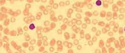 MB Lymfocytose1 800 500