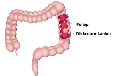 Colorectaalkanker1 800