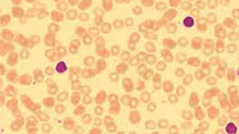MB Lymfocytose1 800 500