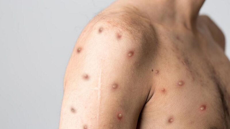 Monkeypox2